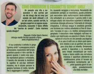 Sorriso Gengivale - Mio