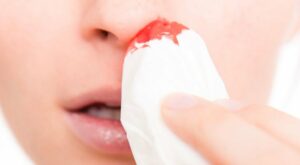 sangue dal naso