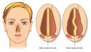 setto nasale deviato